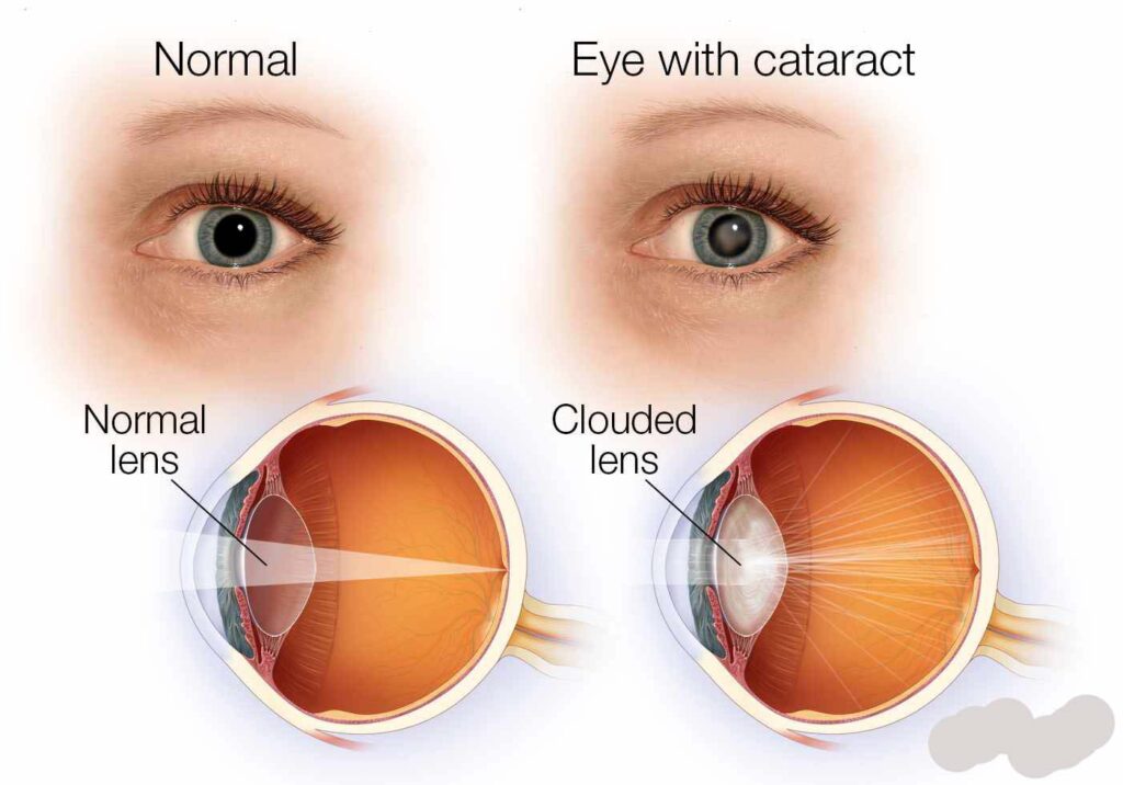 Common symptoms of cataracts